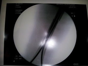X-ray of Drew's leg with titanium rods inserted. You can see the break in the femur at the top right part of the image.
